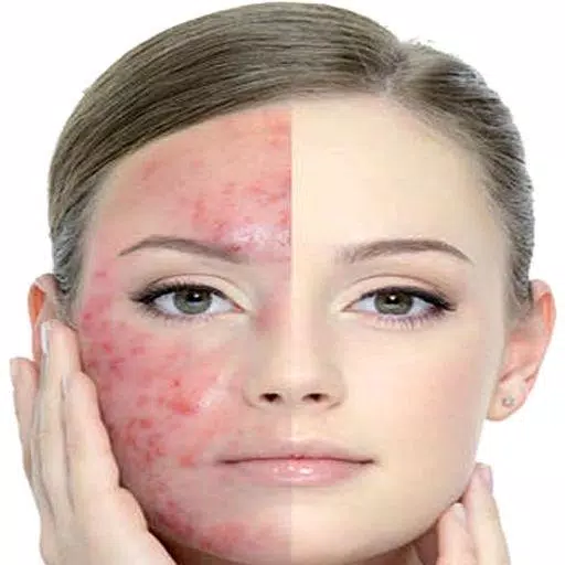 Get Rid of Acne  (Guide) স্ক্রিনশট 1